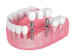 Dental Crowns and Bridges